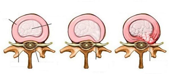 intervertebralna kila s cervikalnom osteohondrozom