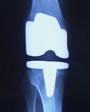 X -Ray Slika koljena s umjetnom protezom nakon operacije za promjenu zgloba